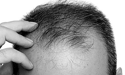  Unshaven Hair Transplantation and Shaved Hair Transplantation