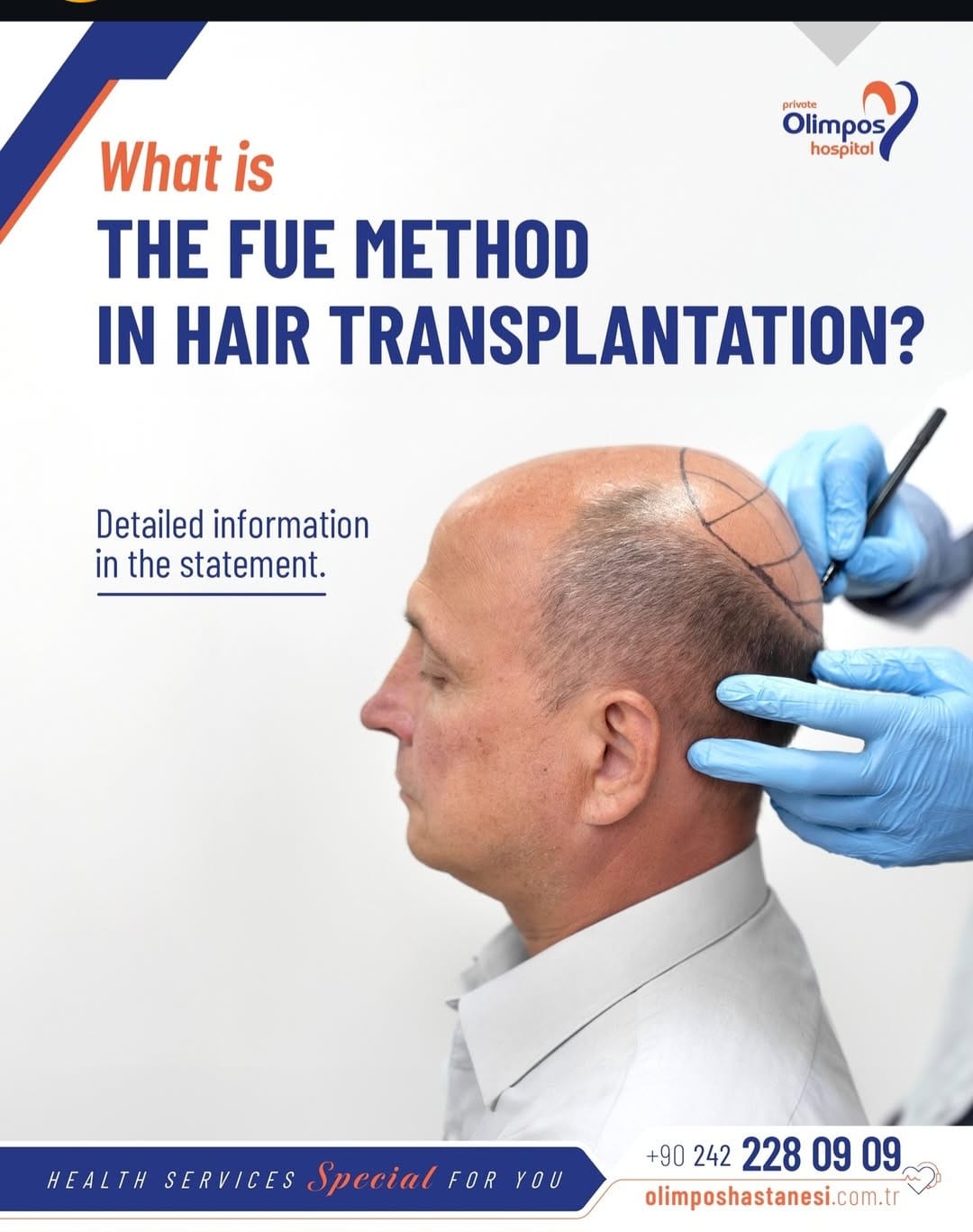 What is the FUE method in hair transplantation? -de